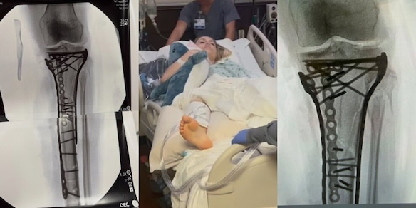 Lindsey Vonn choc: mostra la gamba piena di viti dopo sei operazioni