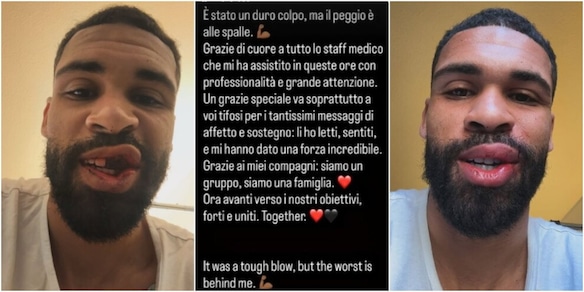 Loftus-Cheek pubblica le foto shock dell'infortunio: denti rotti e una cannuccia per alimentarsi!