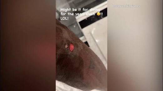 Nba, Lebron James mostra la sua ferita