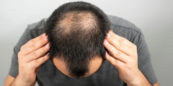 La fine delle calvizie nel mondo, un medico annuncia la data