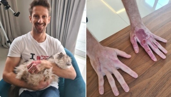 F1: Grosjean mostra le sue mani, non più fasciate, sui social