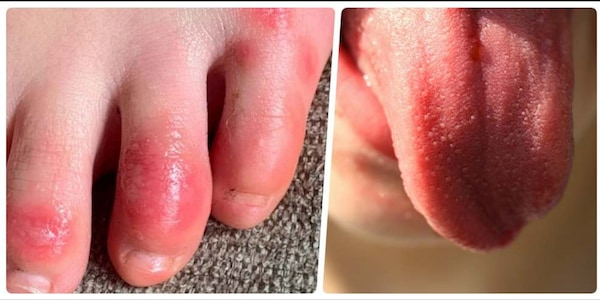 Lingua pelosa, piedi viola: i sintomi più assurdi del Covid