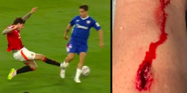La foto raccapricciante del taglio sulla gamba in United-Athletic: "Per l'arbitro neanche fallo..."