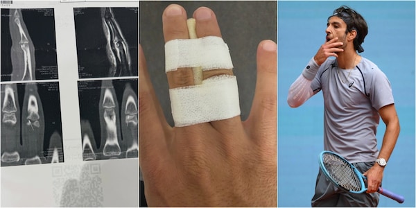 Musetti si infortuna alla mano destra e posta sui social la foto della lastra: salta Tokyo