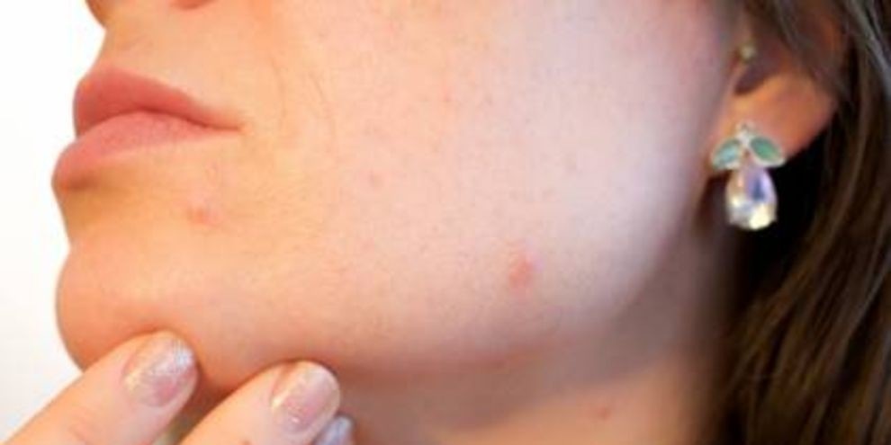 Schiaccia Un Brufolo Sul Naso E Rischia Di Diventare Cieca Dramma Per 
