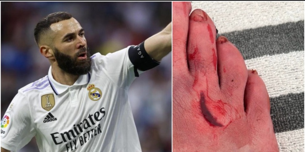 La scioccante foto di Benzema: guardate il piede come è ridotto!